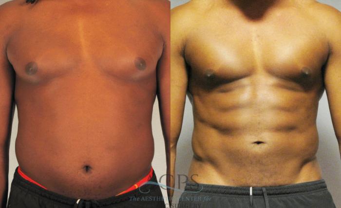 Before & After Abdominal Etching Case 789 Front View: View in Houston, TX
