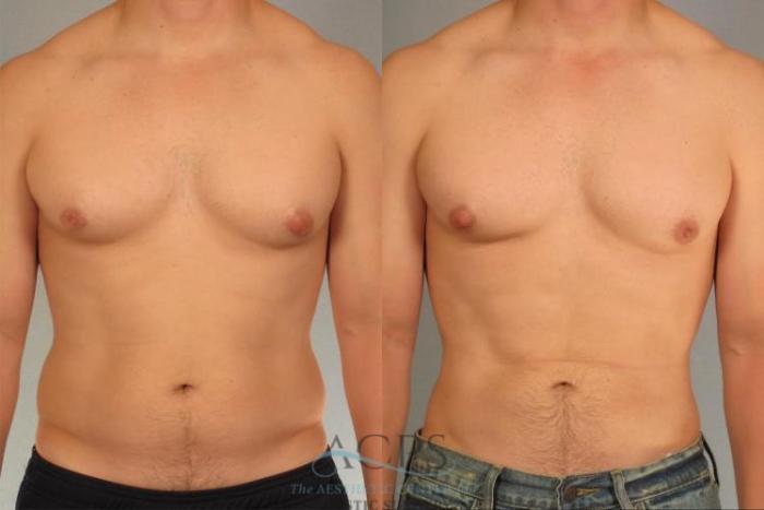 Before & After Abdominal Etching Case 793 Front View: View in Houston, TX