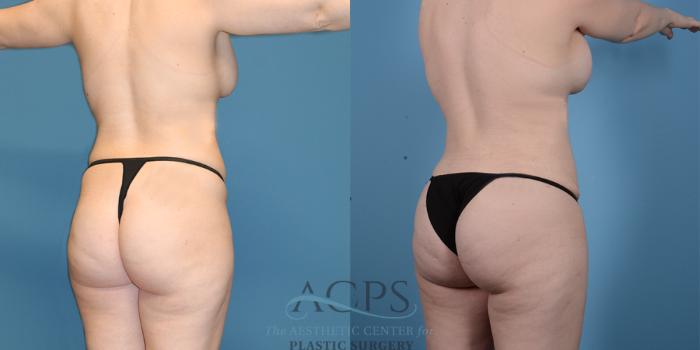 Before & After Brazilian Butt Lift (BBL) Case 409 Oblique View: View in Houston, TX