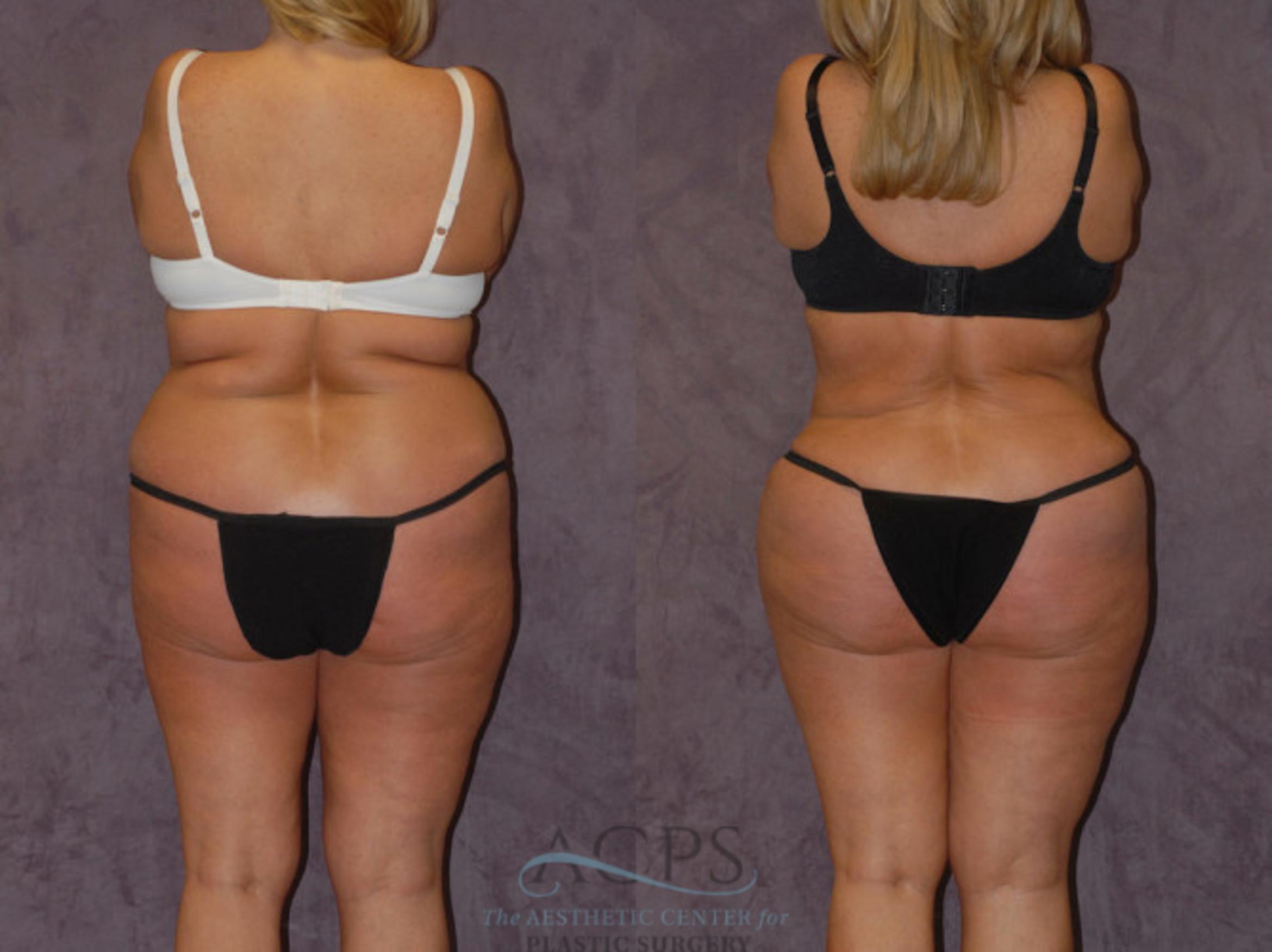 Before & After Brazilian Butt Lift (BBL) Case 431 Rear View: View in Houston, TX