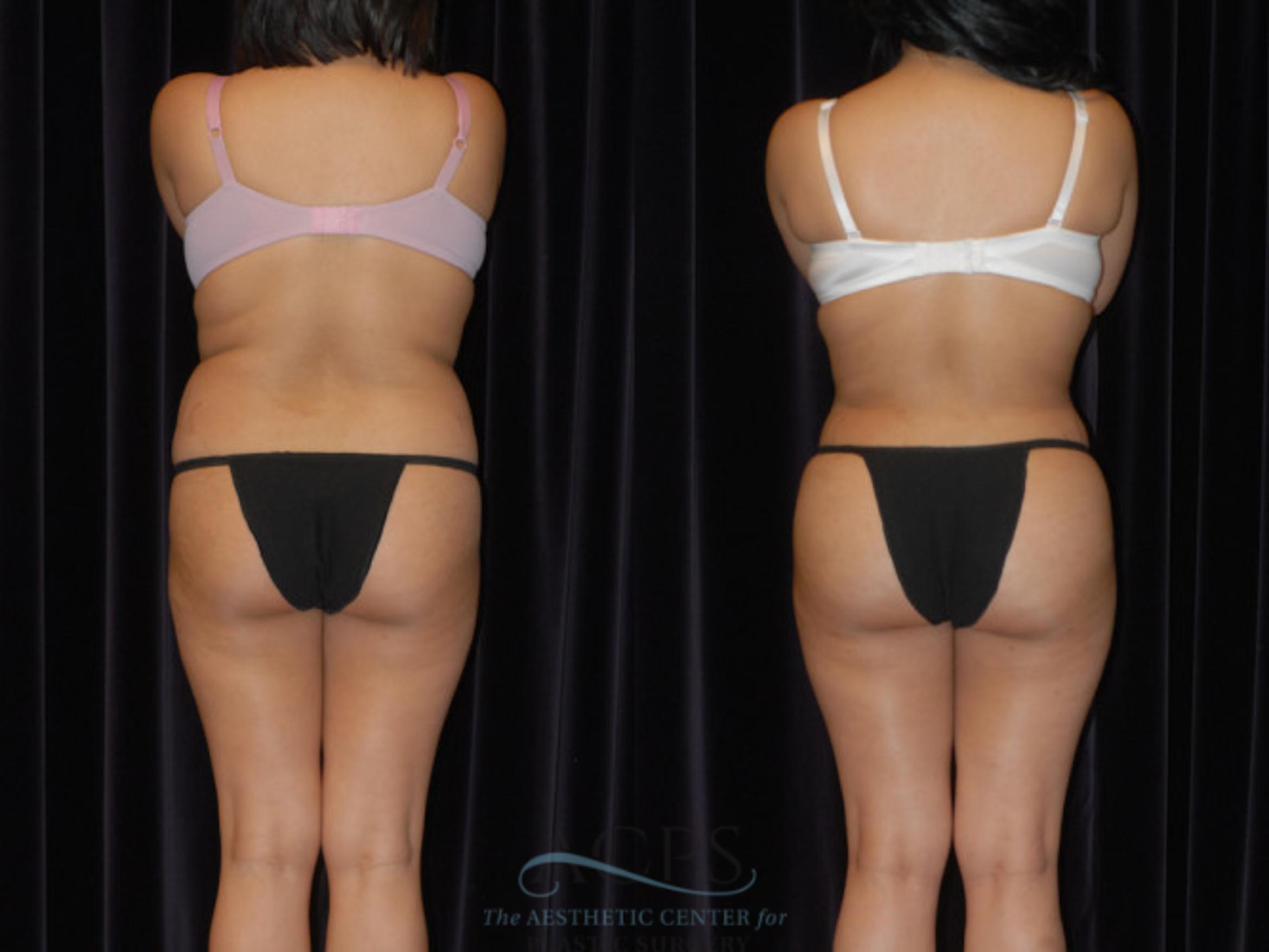Before & After Brazilian Butt Lift (BBL) Case 441 Rear View: View in Houston, TX