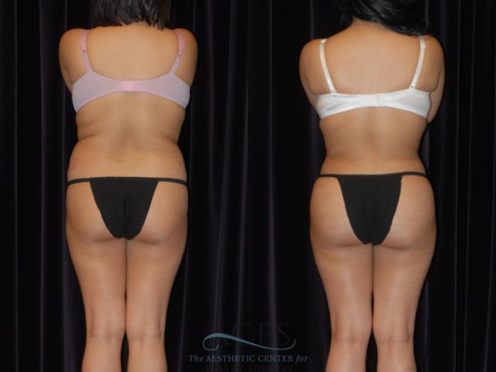 Before & After Brazilian Butt Lift (BBL) Case 441 Rear View: View in Houston, TX