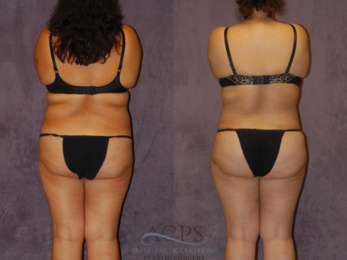 Before & After Brazilian Butt Lift (BBL) Case 446 Rear View: View in Houston, TX