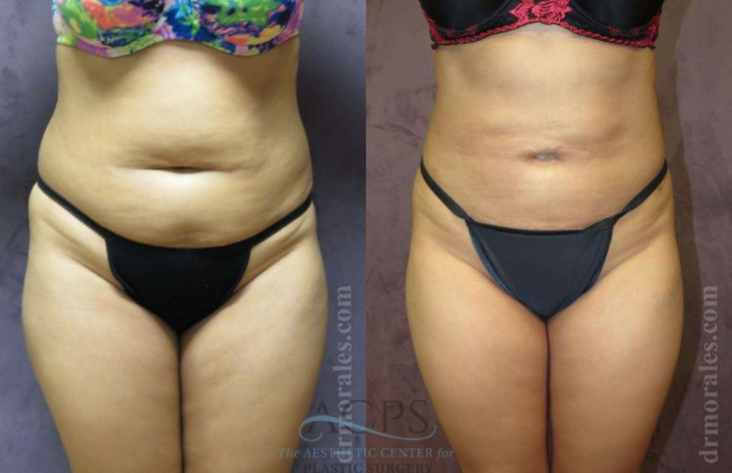 Before & After Brazilian Butt Lift (BBL) Case 498 Front View: View in Houston, TX