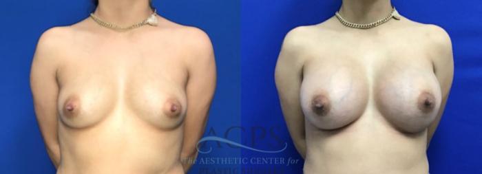 Before & After Breast Augmentation Case 1528 Front View in Houston, TX