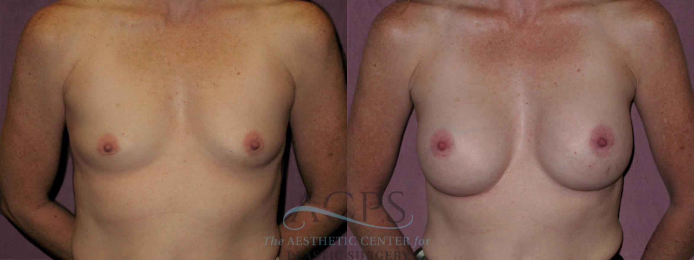 Before & After Breast Augmentation Case 928 Front View: View in Houston, TX