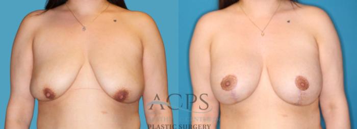 Before & After Breast Lift Case 1522 Front View in Houston, TX