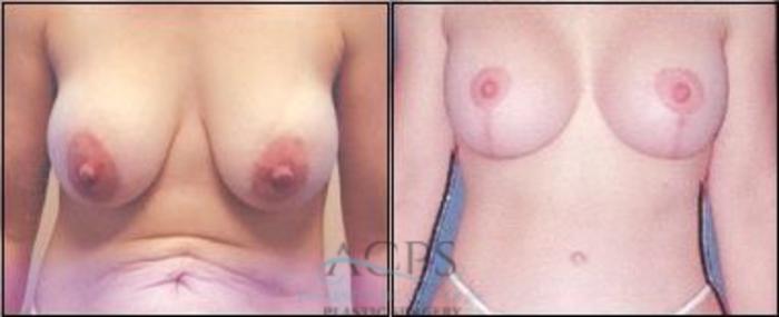 Before & After Breast Lift Case 1148 Front View: View in Houston, TX