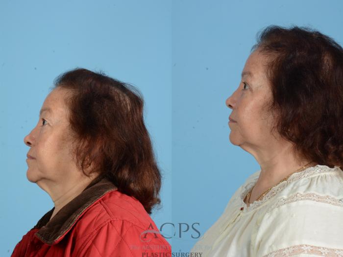 Before & After Fat Grafting Case 1554 Left Side View in Houston, TX