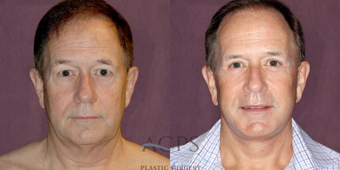 Before & After Neck Lift Case 1255 Front View: View in Houston, TX