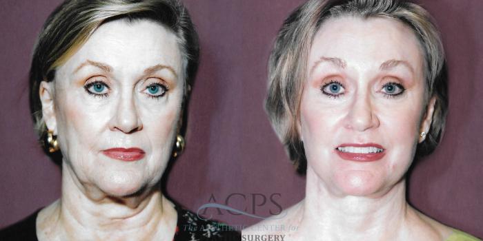 Before & After Neck Lift Case 1257 Front View: View in Houston, TX