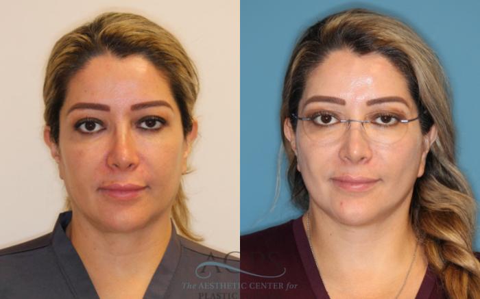 Before & After Neck Lift Case 1502 Front View in Houston, TX