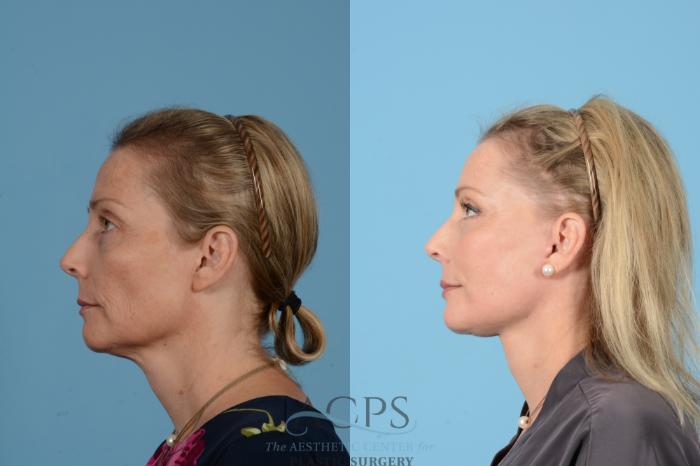 Before & After Fat Grafting Case 1517 Left Side View in Houston, TX