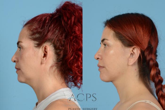 Before & After Otoplasty Case 1555 Left Side View in Houston, TX