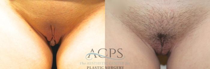 Before & After Labiaplasty Case 801 Front - 2 View: View in Houston, TX