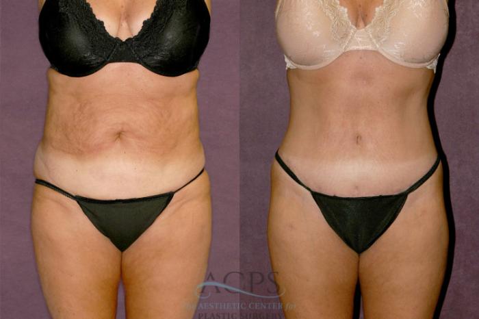 Before & After Liposuction Case 347 Front View: View in Houston, TX