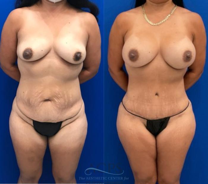 Before & After Tummy Tuck Case 1495 Front View in Houston, TX