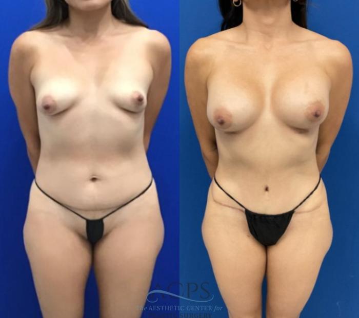Before & After Tummy Tuck Case 1496 Front View in Houston, TX