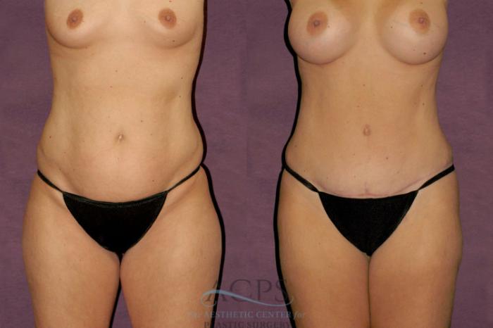 Before & After Body Lift Case 106 Front View: View in Houston, TX