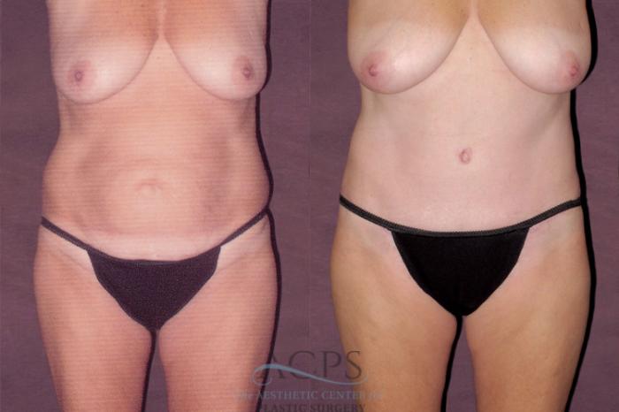 Before & After Liposuction Case 113 Front View: View in Houston, TX