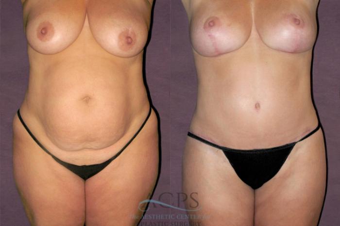 Before & After Tummy Tuck Case 123 Front View: View in Houston, TX