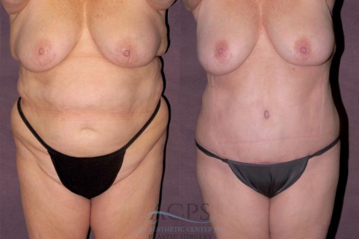 Before & After Body Lift Case 124 Front View: View in Houston, TX