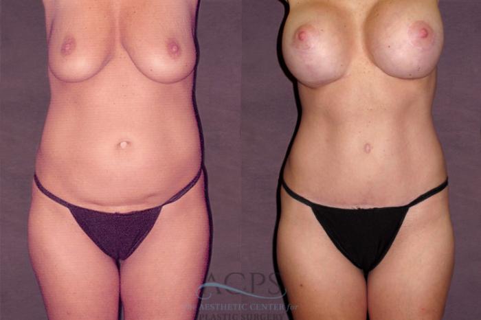 Before & After Liposuction Case 127 Front View: View in Houston, TX
