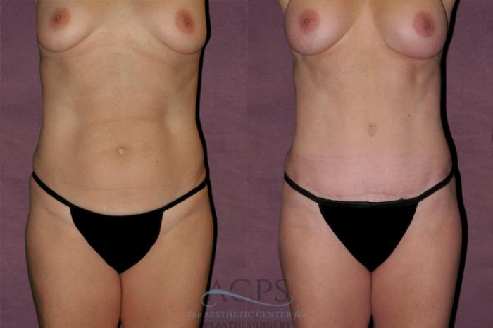 Before & After Tummy Tuck Case 137 Front View: View in Houston, TX
