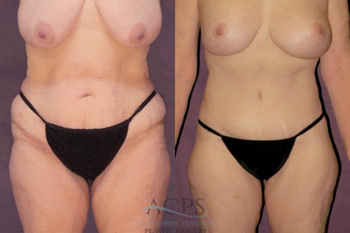 Before & After Body Lift Case 142 Front View: View in Houston, TX