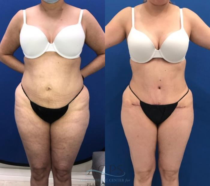 Before & After Tummy Tuck Case 1498 Front View in Houston, TX