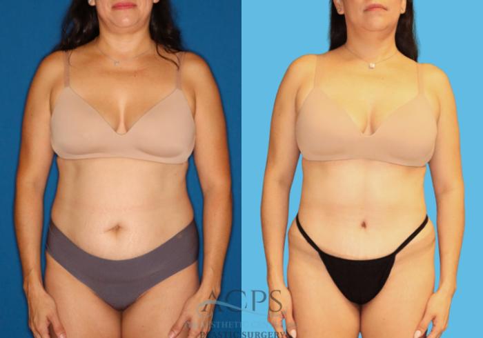 Before & After Tummy Tuck Case 1530 Front View in Houston, TX
