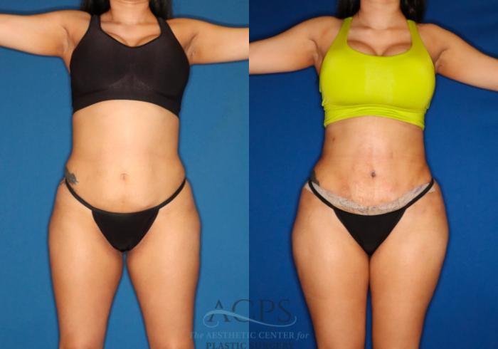 Before & After Tummy Tuck Case 1531 Front View in Houston, TX