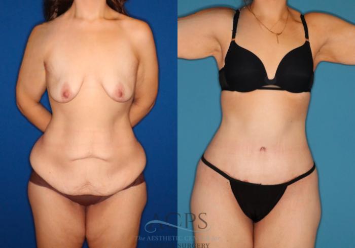 Before & After Tummy Tuck Case 1532 Front View in Houston, TX