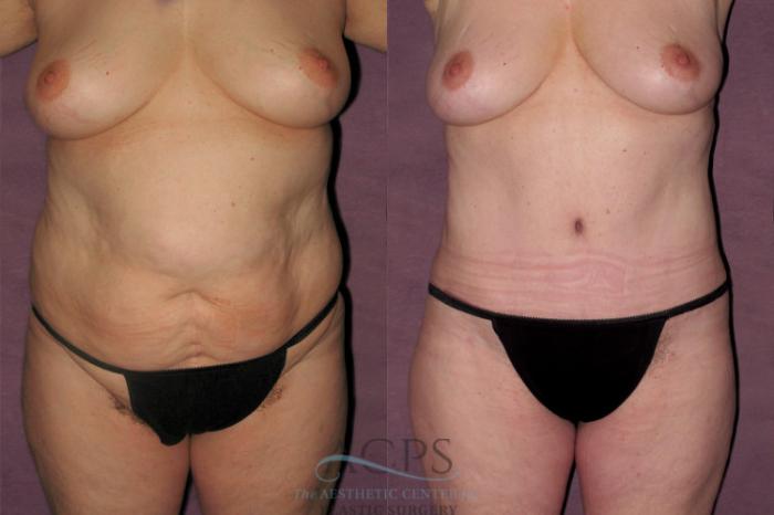 Before & After Tummy Tuck Case 155 Front View: View in Houston, TX