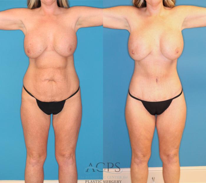 Before & After Tummy Tuck Case 1551 Front View in Houston, TX