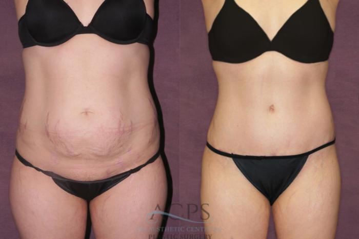 Before & After Liposuction Case 159 Front View: View in Houston, TX