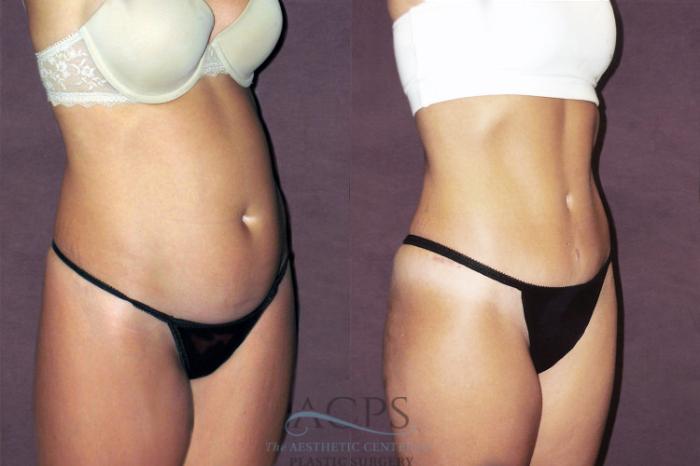 Before & After Tummy Tuck Case 163 Oblique Right View: View in Houston, TX