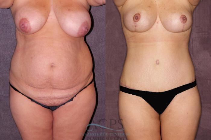 Before & After True Form Tummy Tuck Case 167 Front View: View in Houston, TX