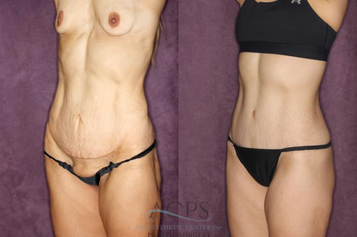 Before & After Body Lift Case 25 Oblique Left View: View in Houston, TX