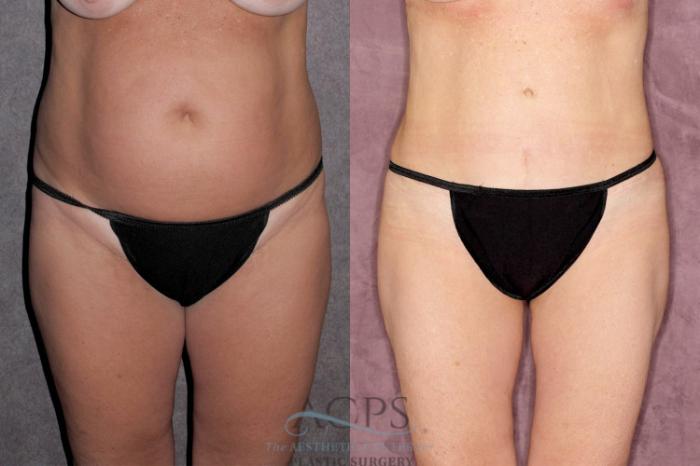 Before & After Liposuction Case 29 Front View: View in Houston, TX