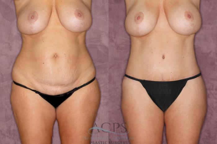 Before & After Brazilian Butt Lift (BBL) Case 37 Front View: View in Houston, TX