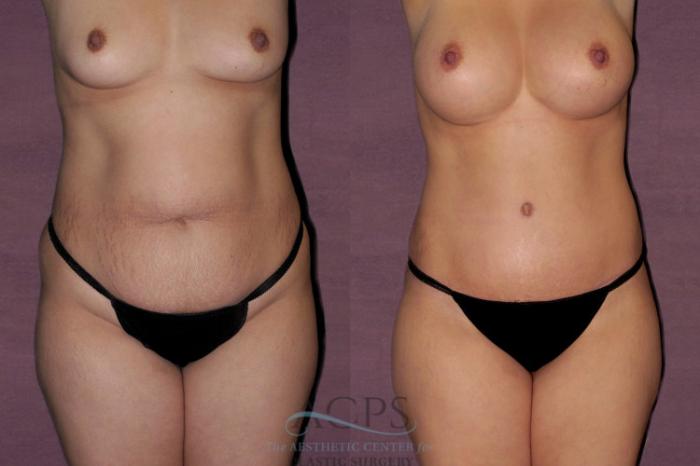 Before & After Liposuction Case 40 Front View: View in Houston, TX