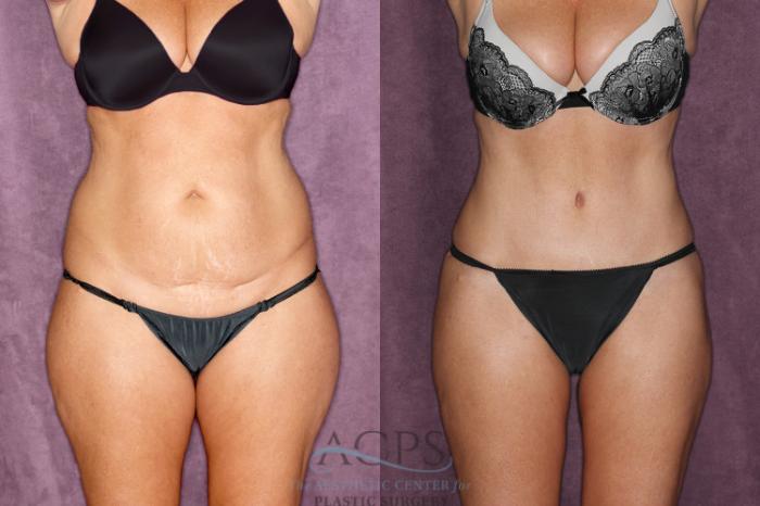 Before & After Liposuction Case 48 Front View: View in Houston, TX