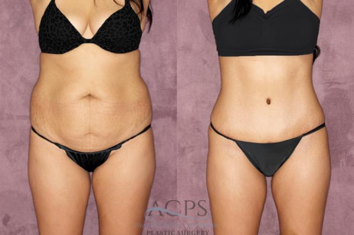 Before & After Tummy Tuck Case 50 Front View: View in Houston, TX