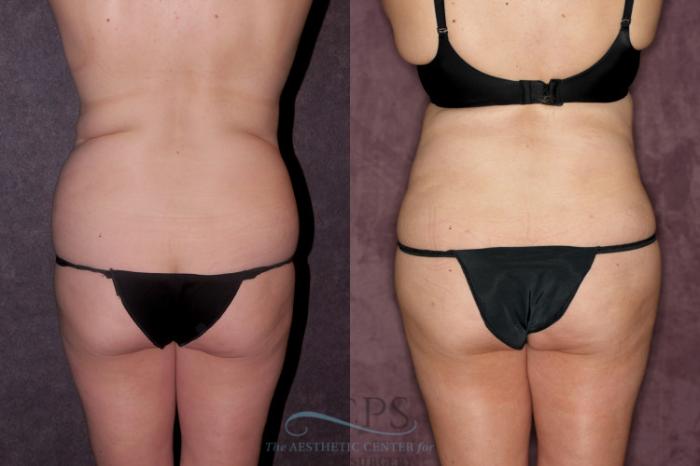 Before & After Tummy Tuck Case 54 Front View: View in Houston, TX