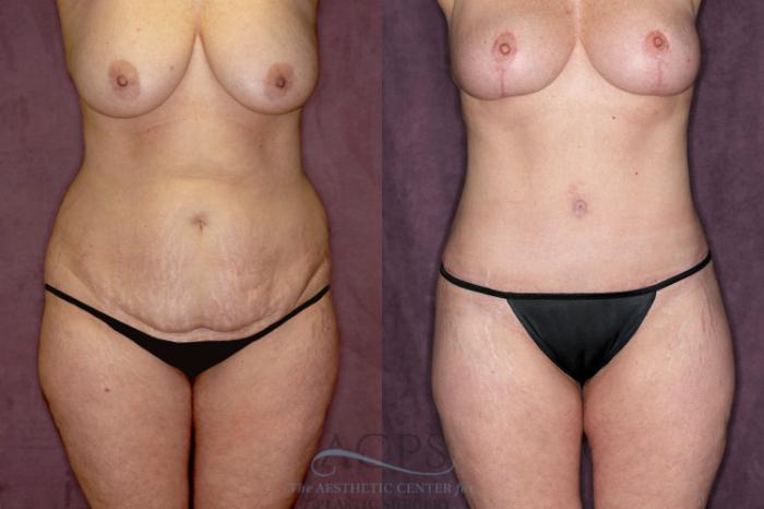 Before & After Liposuction Case 55 Front View: View in Houston, TX