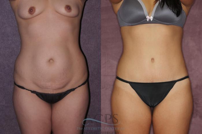 Before & After True Form Tummy Tuck Case 71 Front View: View in Houston, TX