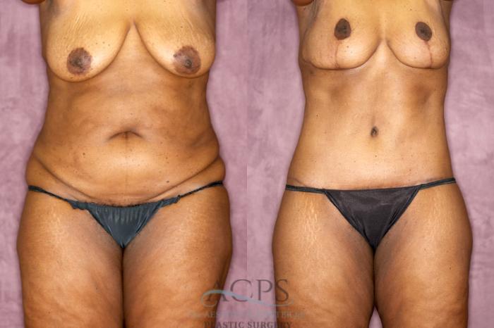 Before & After Body Lift Case 75 Front View: View in Houston, TX