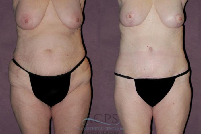Before & After Body Lift Case 79 Front View: View in Houston, TX