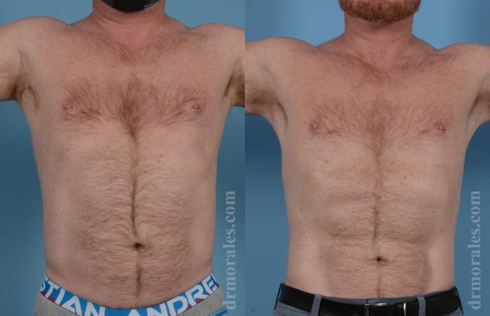 Before & After Male Body Contouring Case 1537 Front View in Houston, TX